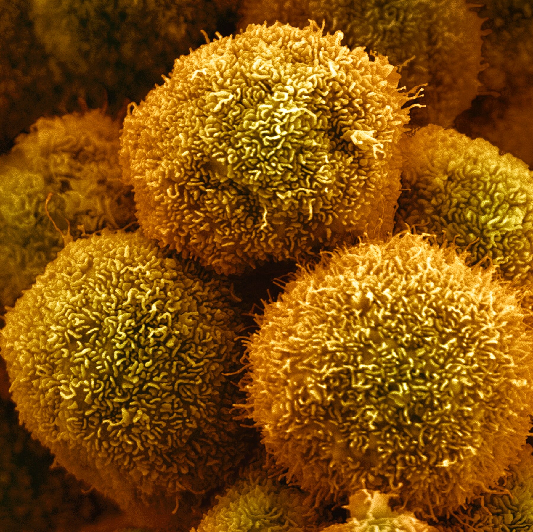 You are currently viewing New Drug Approved by F.D.A. for Pancreatic Cancer Could Be First of Many