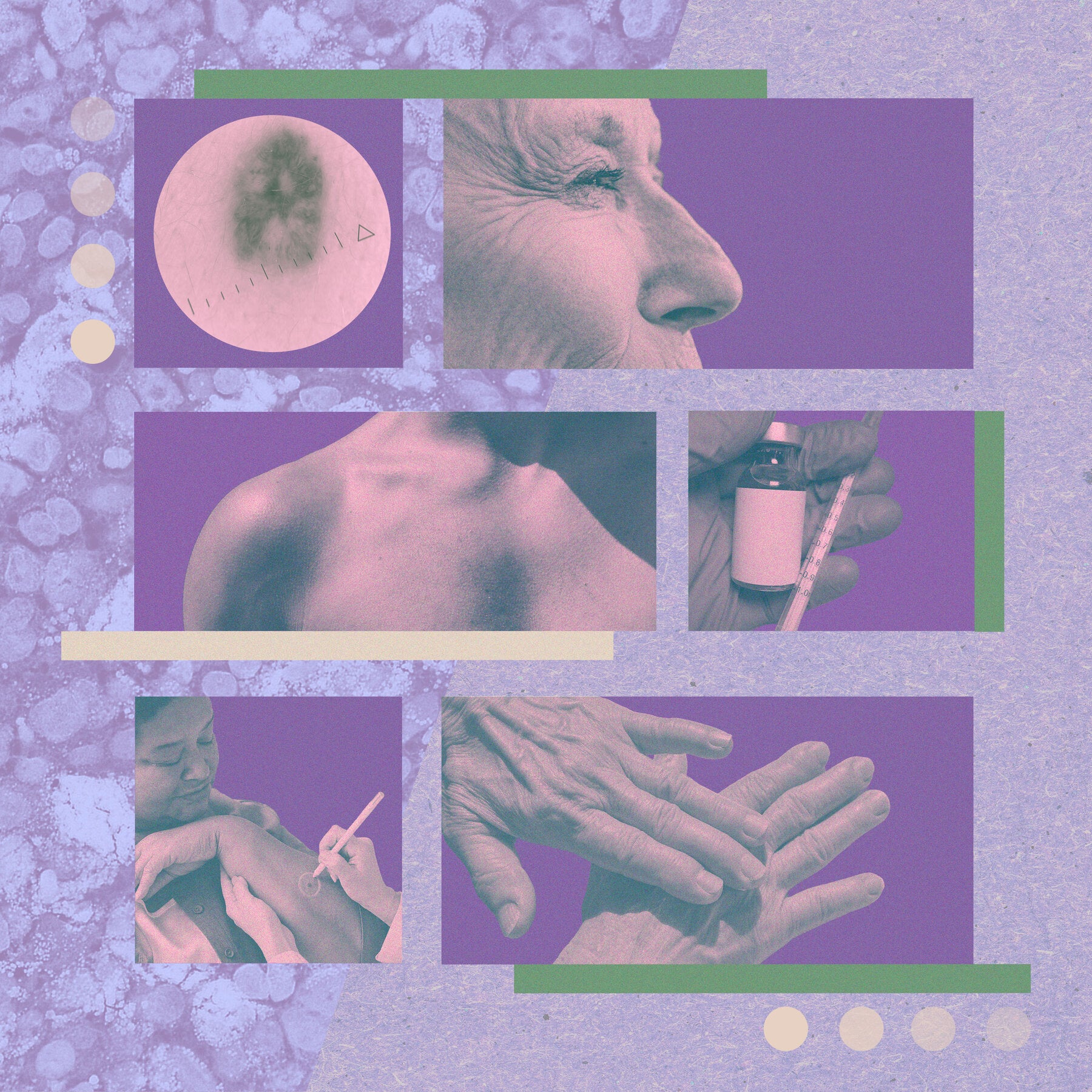 You are currently viewing Melanoma Vaccine Ushers in New Hope for Cancer Patients